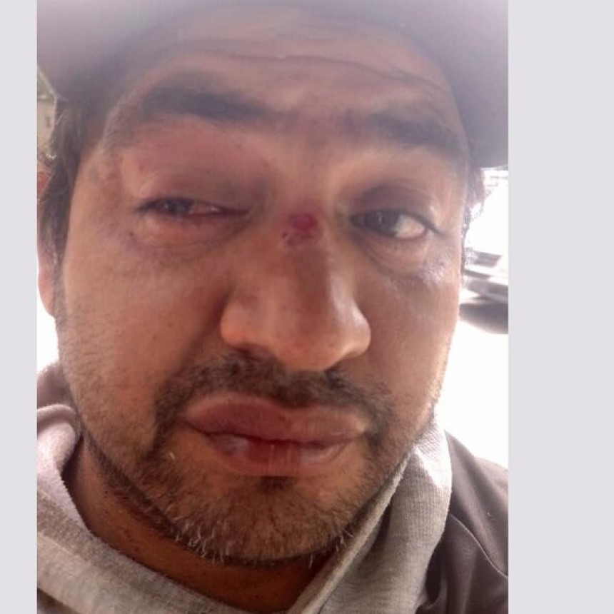 DIARIOKTUBRE INFO….PROTOCOLO ANTIPROTESTA UN MANFIESTANTE PERDIÓ LA VISIÓN DE UN OJO POR LA REPRESIÓN    ….Por Simòn Suàrez